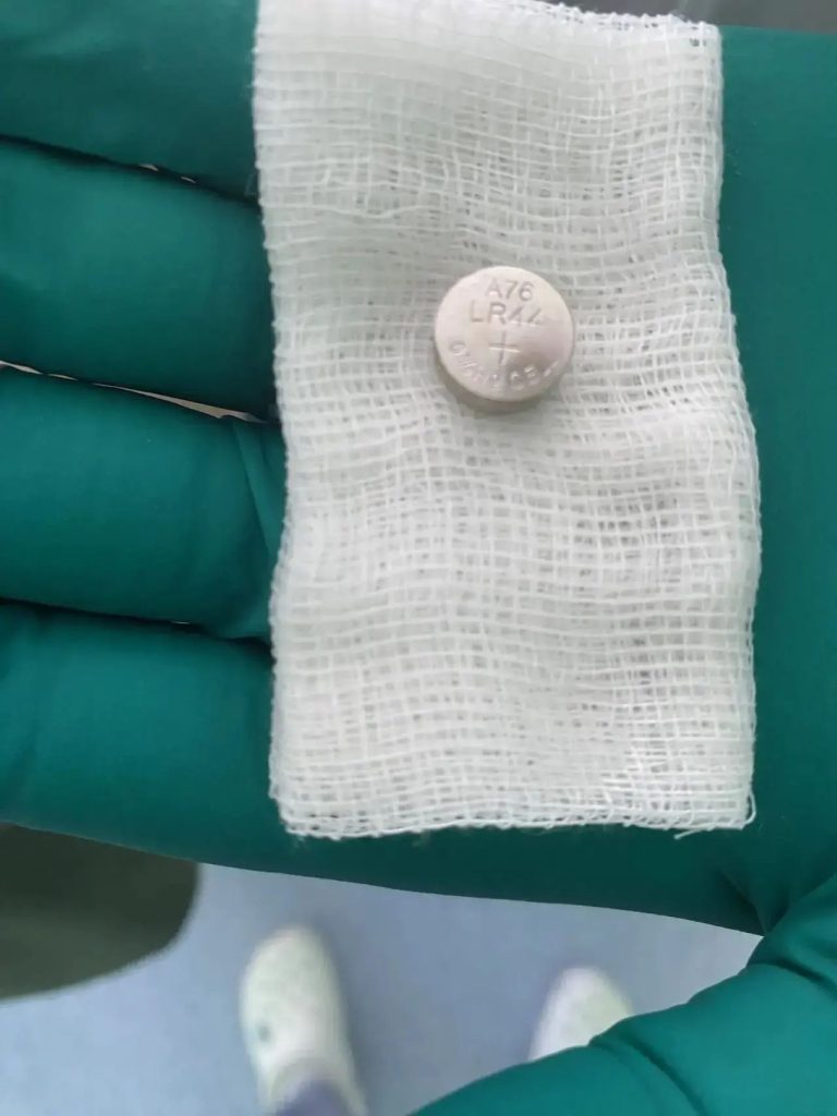 В ХМАО врачи спасли 10‑месячного младенца: из желудка ребёнка извлекли проглоченную батарейку