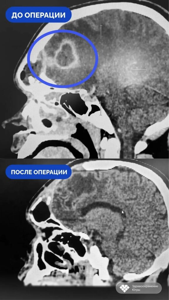 Четыре месяца самолечения: сургутские врачи спасли пациента с абсцессом мозга