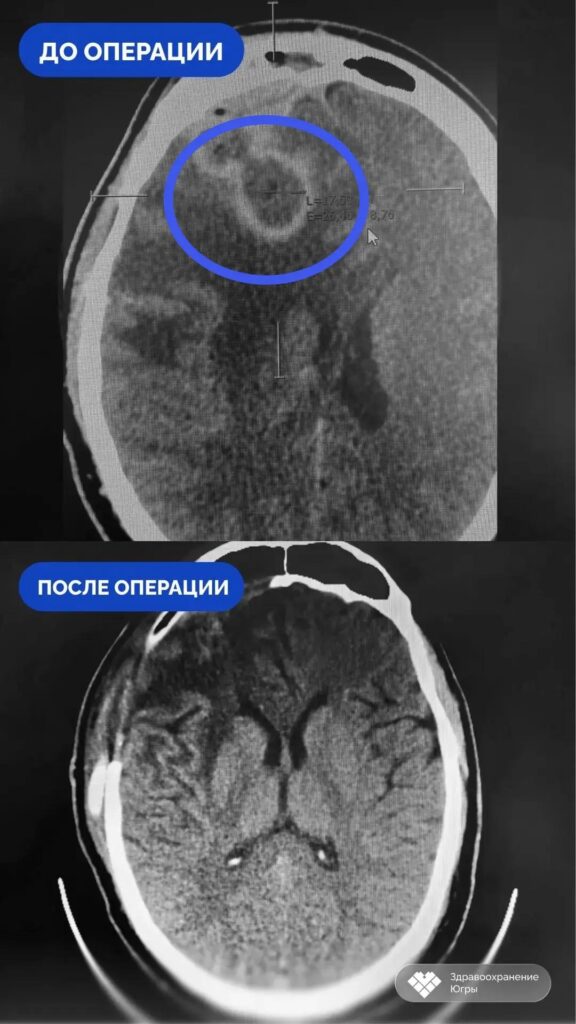 Четыре месяца самолечения: сургутские врачи спасли пациента с абсцессом мозга