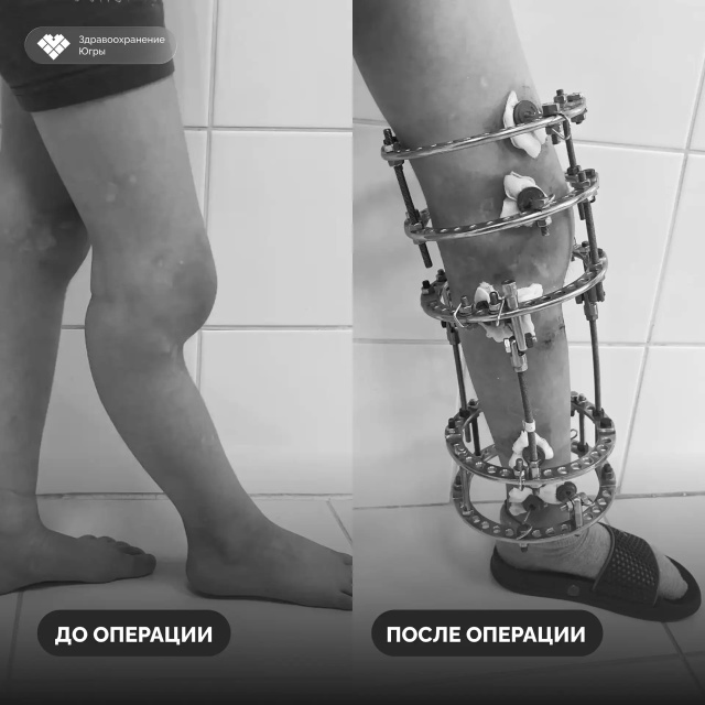 Нижневартовские врачи устранили деформацию голени у шестилетнего пациента Нижневартовские врачи устранили деформацию голени у шестилетнего пациента